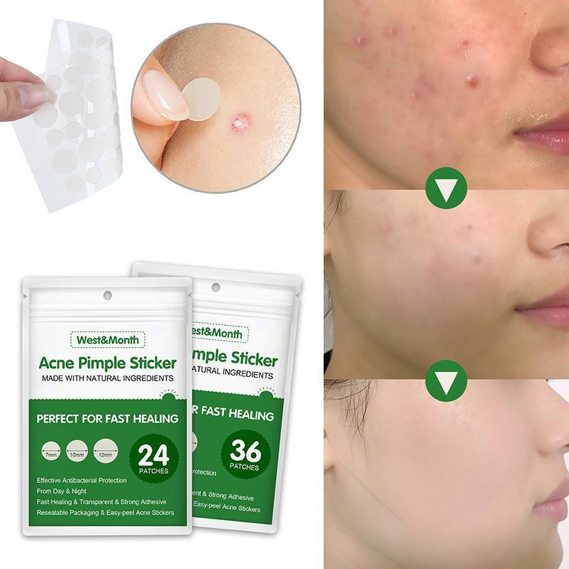 Acne pimple stickers with packaging and before-and-after effects on skin.
